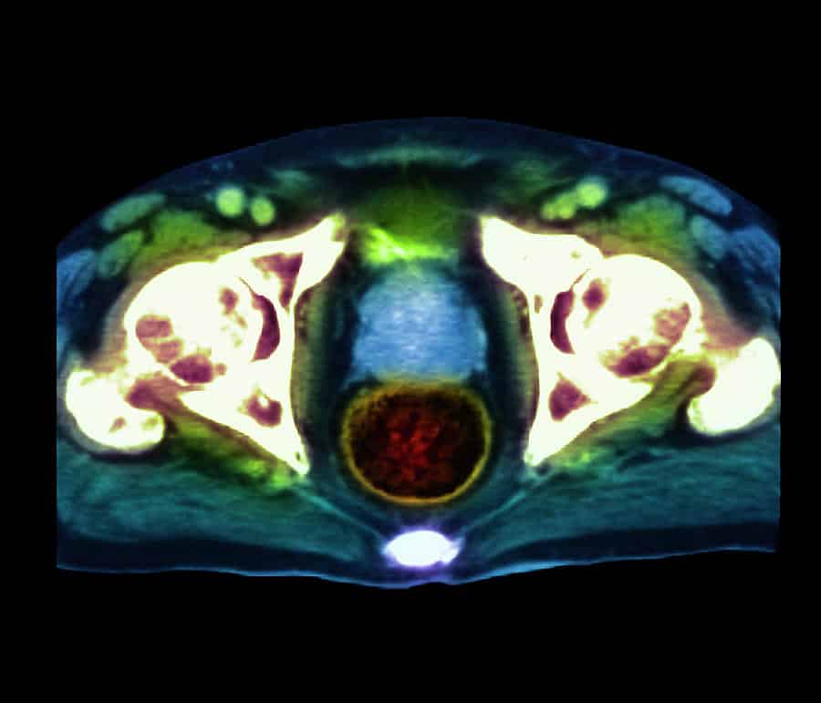 Prostate Cancer Photograph by Simon Fraser/science Photo Library
