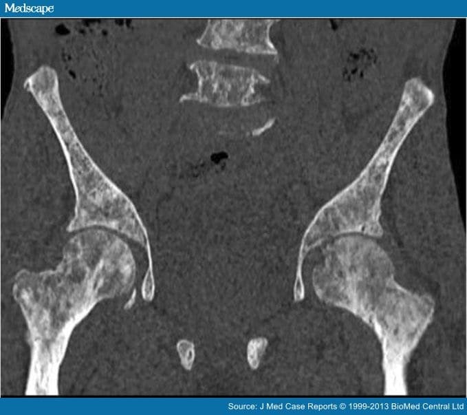 Prostate Cancer Presenting With Metastatic Bone Lesions
