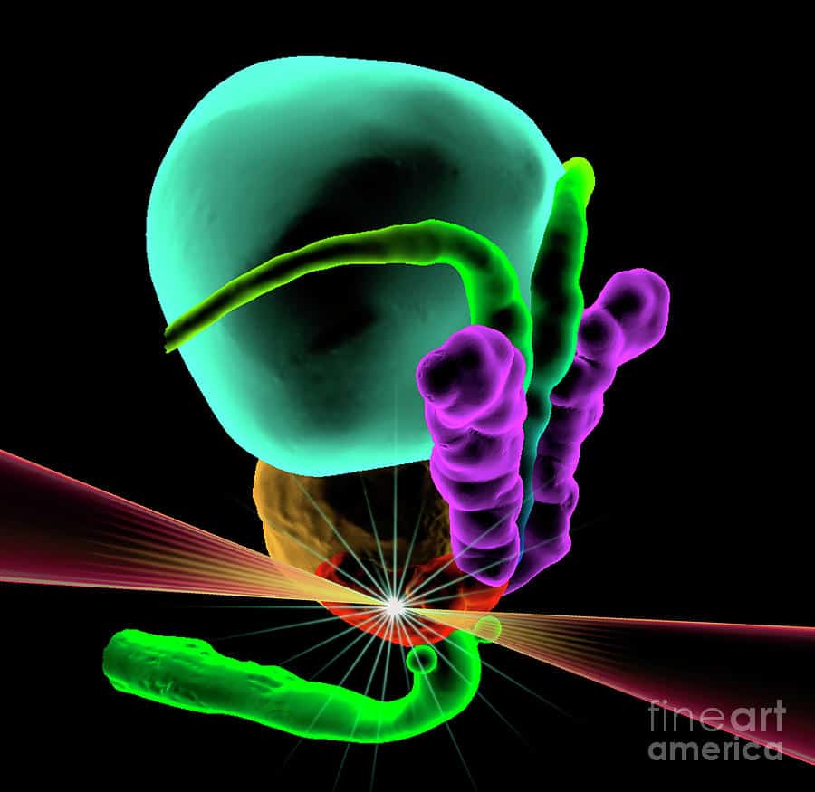 Prostate Cancer Radiotherapy Photograph by K H Fung/science Photo Library