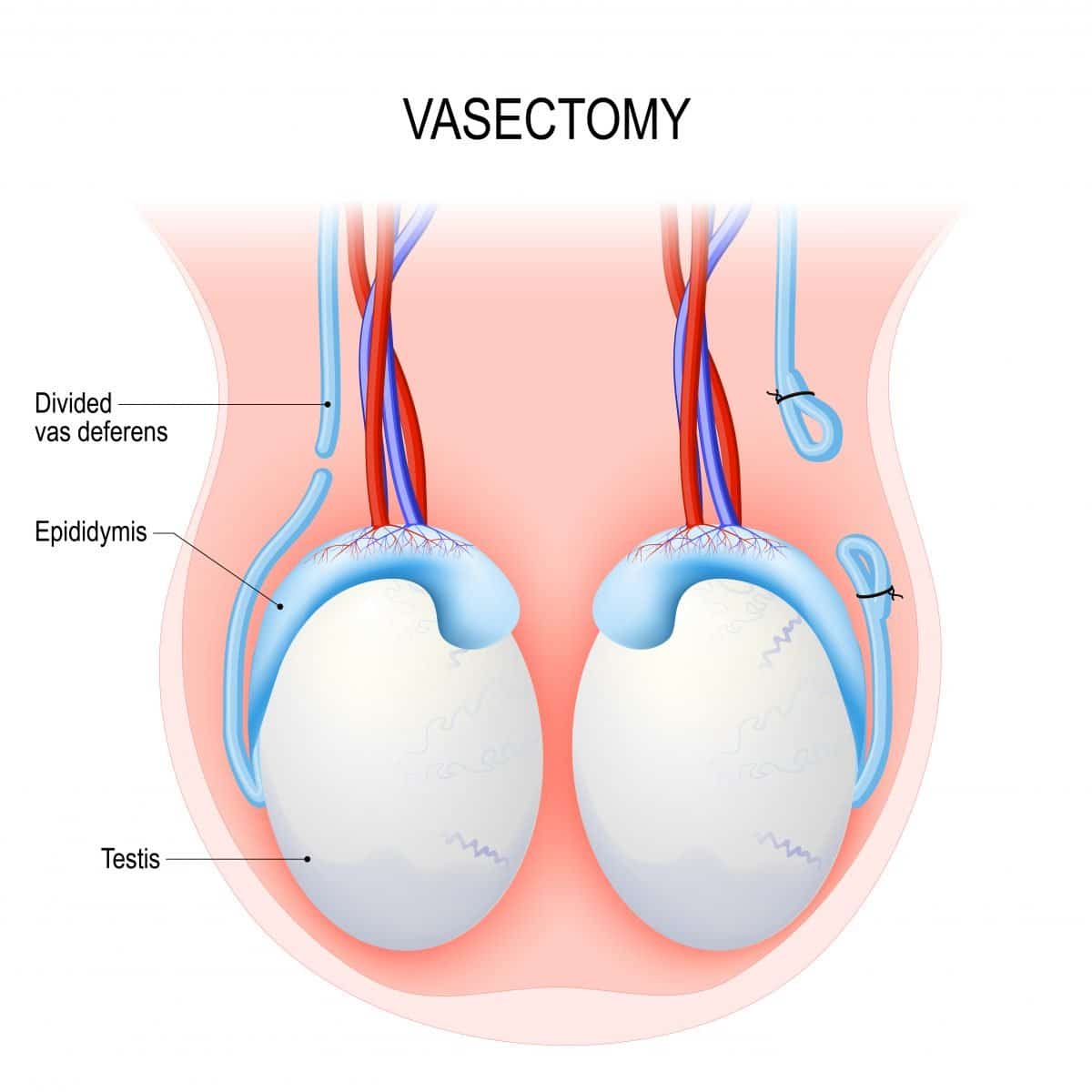 Prostate Cancer Risk Does Not Increase with Vasectomy, Study Reports
