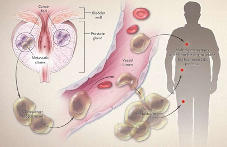 Prostate Cancer Spread Metastatic to Bones Life Expectancy