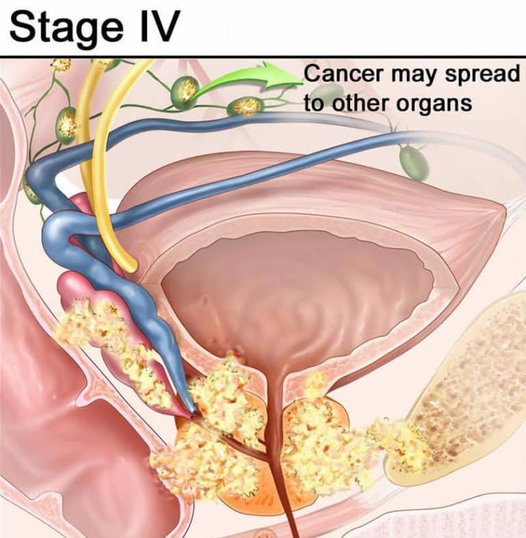 Prostate Cancer Stage 4 Survival