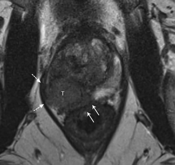 treatment-for-prostate-cancer-with-seminal-vesicle-invasion