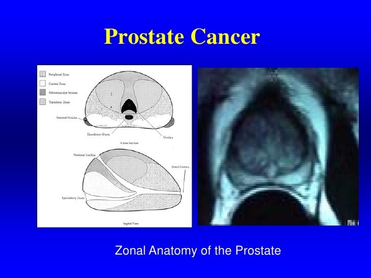 Prostate Cancer Staging Perineural Invasion