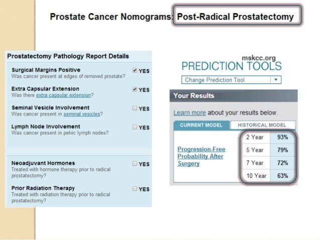 Prostate cancer Survival rate After Prostatectomy
