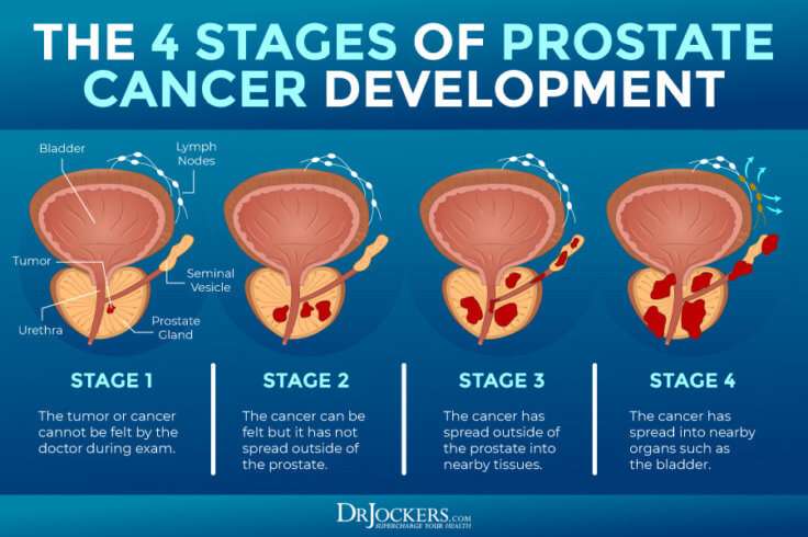 Prostate Cancer: Symptoms, Causes and Support Strategies