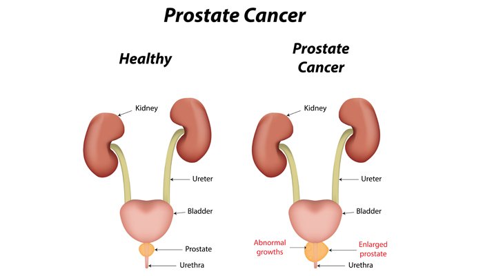 Prostate Cancer  Symptoms, Causes, and Treatment