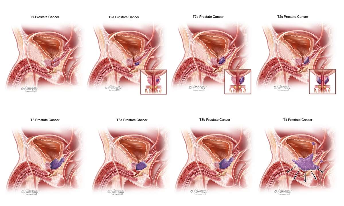Prostate Cancer: Symptoms, Diagnosis &  Treatment