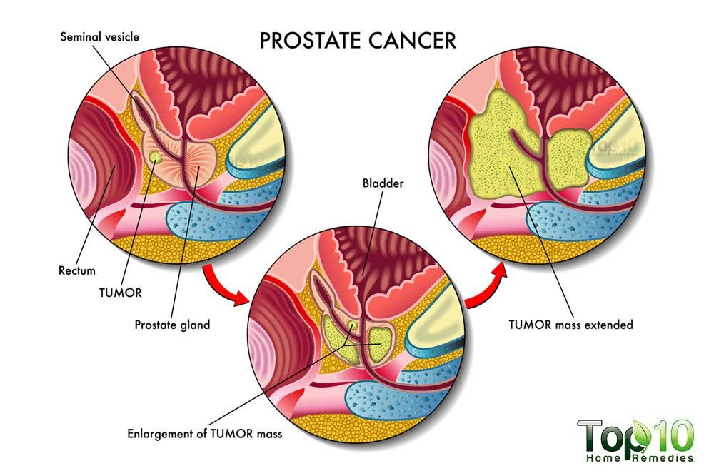 Prostate cancer symptoms Erectile dysfunction