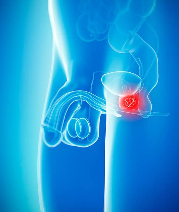 Prostate cancer symptoms: Spotting blood in your urine could indicate ...