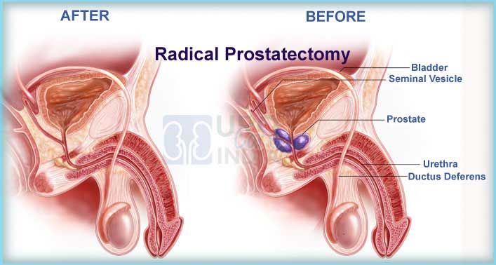 Prostate Cancer Treatment in India: Low Cost &  Affordable