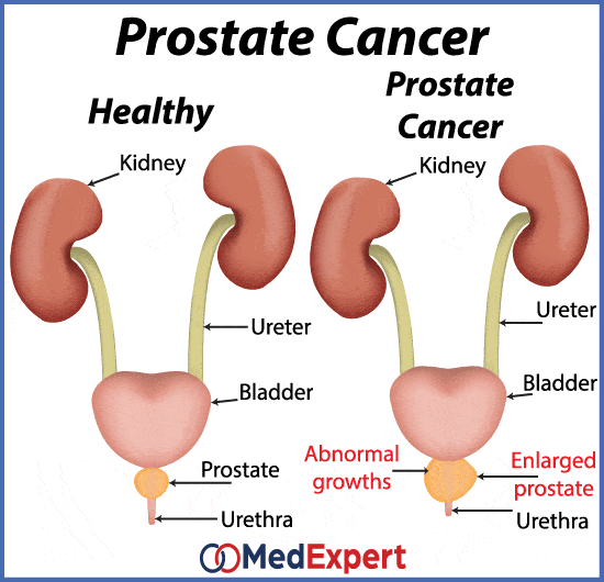 Prostate cancer treatment, symptoms and diagnostic services