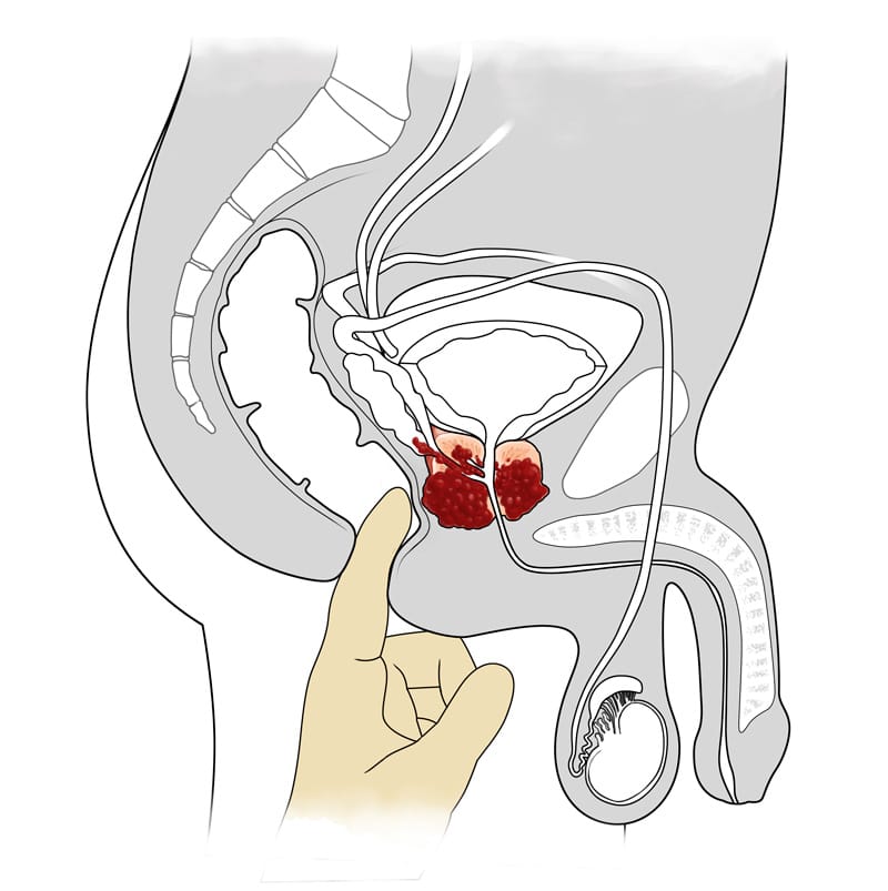Prostate digital rectal exam diagram