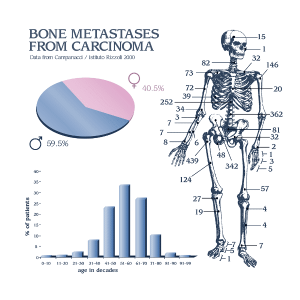 Prostate most cancers treatment For Bone Metastases