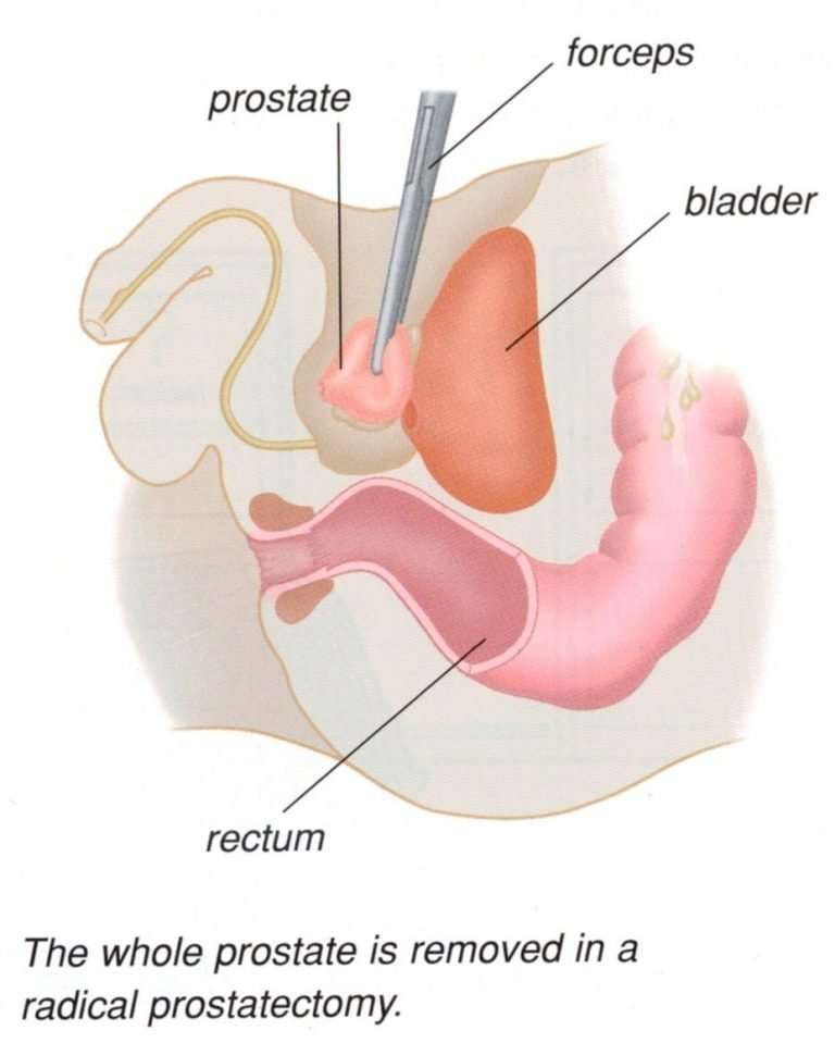 Prostatectomy