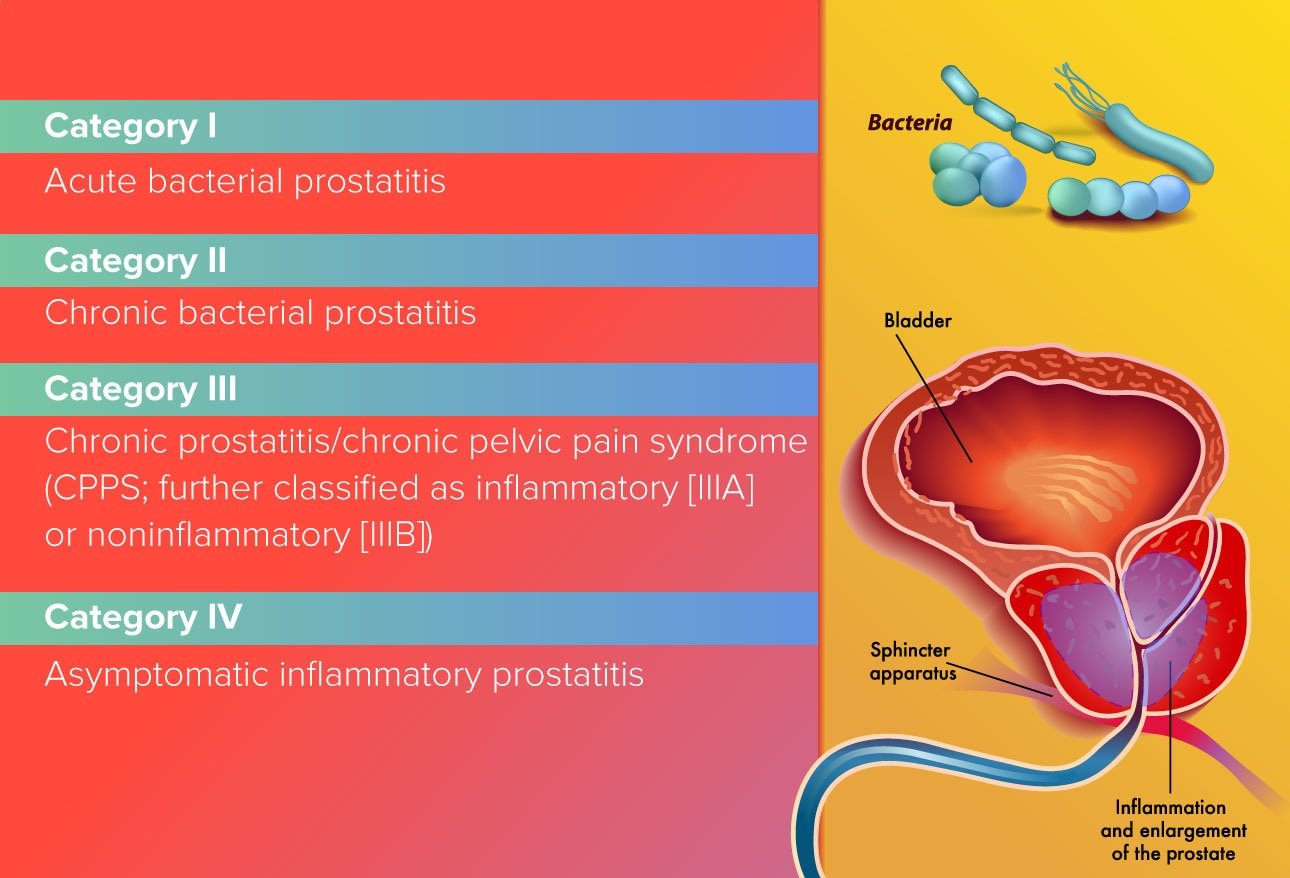 Prostatitis: An Inflammatory Story
