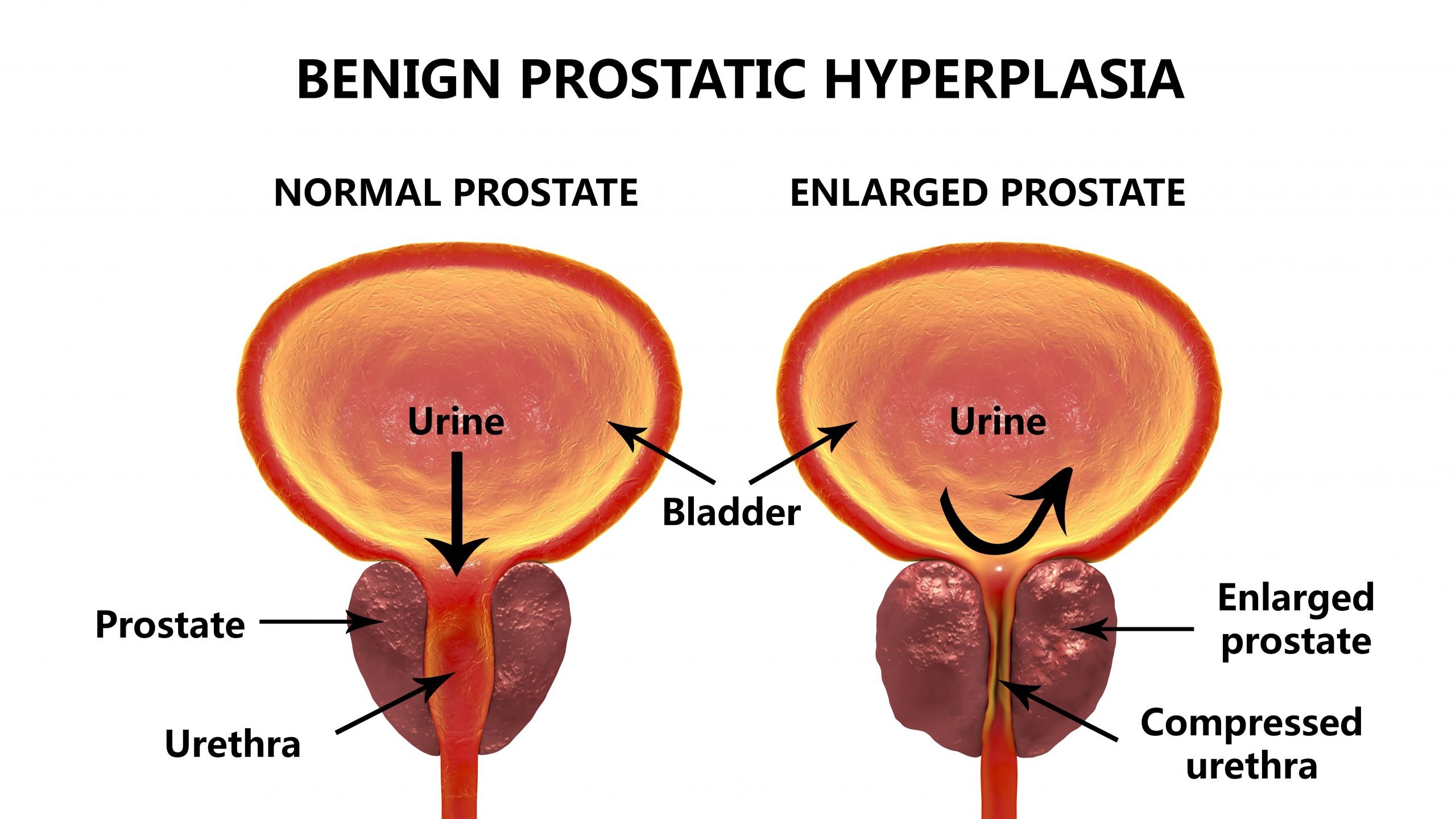 Prostatitis Treatment Bangalore