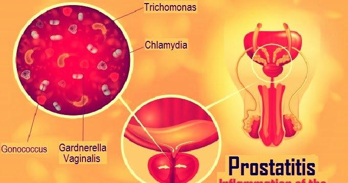 Prostatitis: Types, Symptoms and Causes