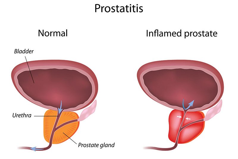 Prostatitis: Types, Symptoms, Causes and Treatments