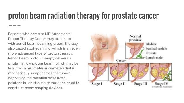 Proton Therapy for Prostate Cancer