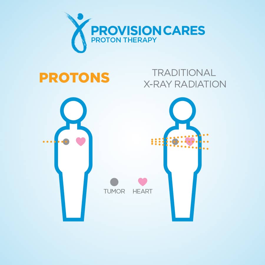 Proton Therapy Prostate Cancer Survival Rates