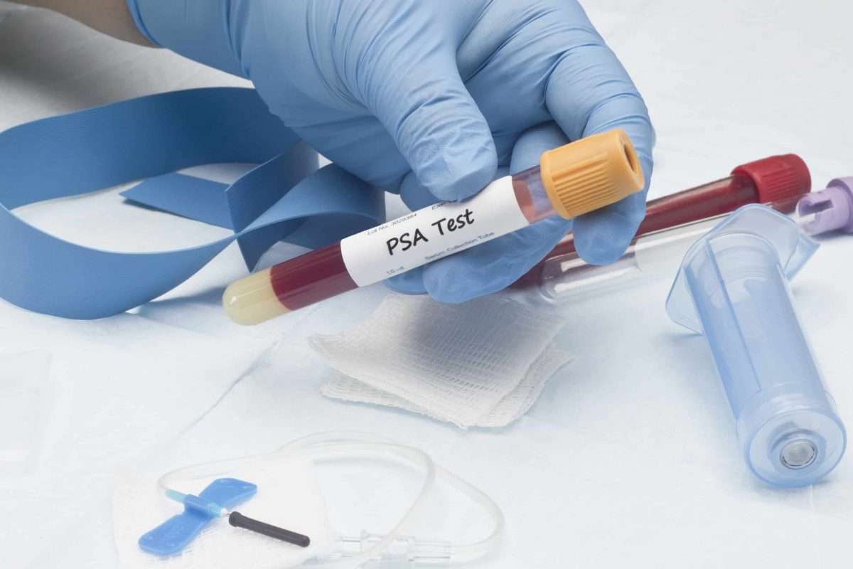 (PSA)Prostate specific antigen blood test