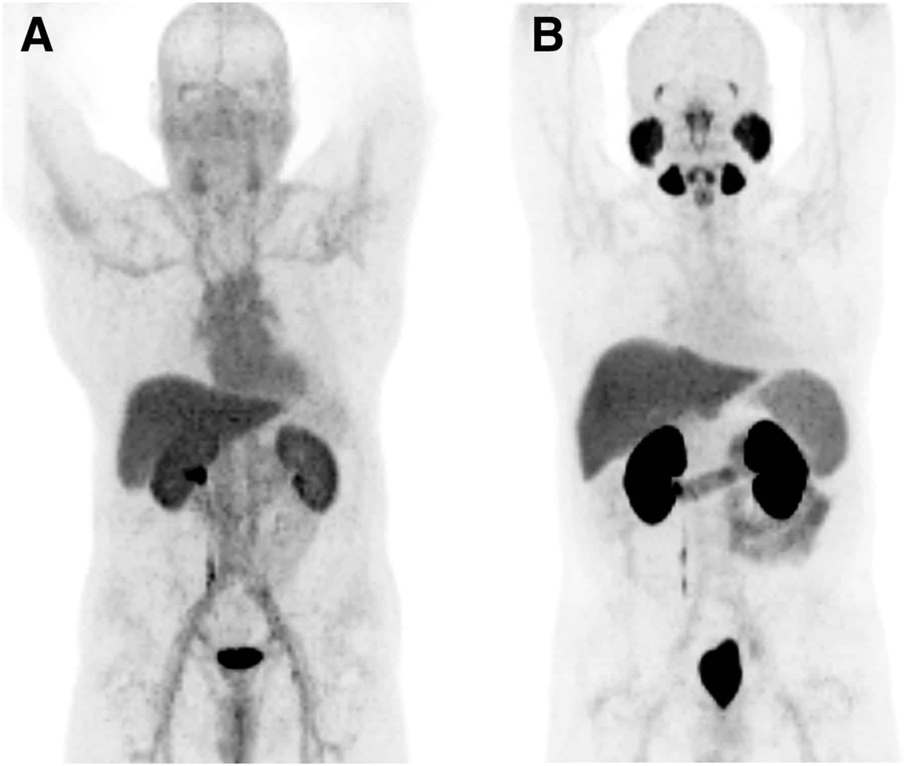 PSMA Ligands for PET Imaging of Prostate Cancer