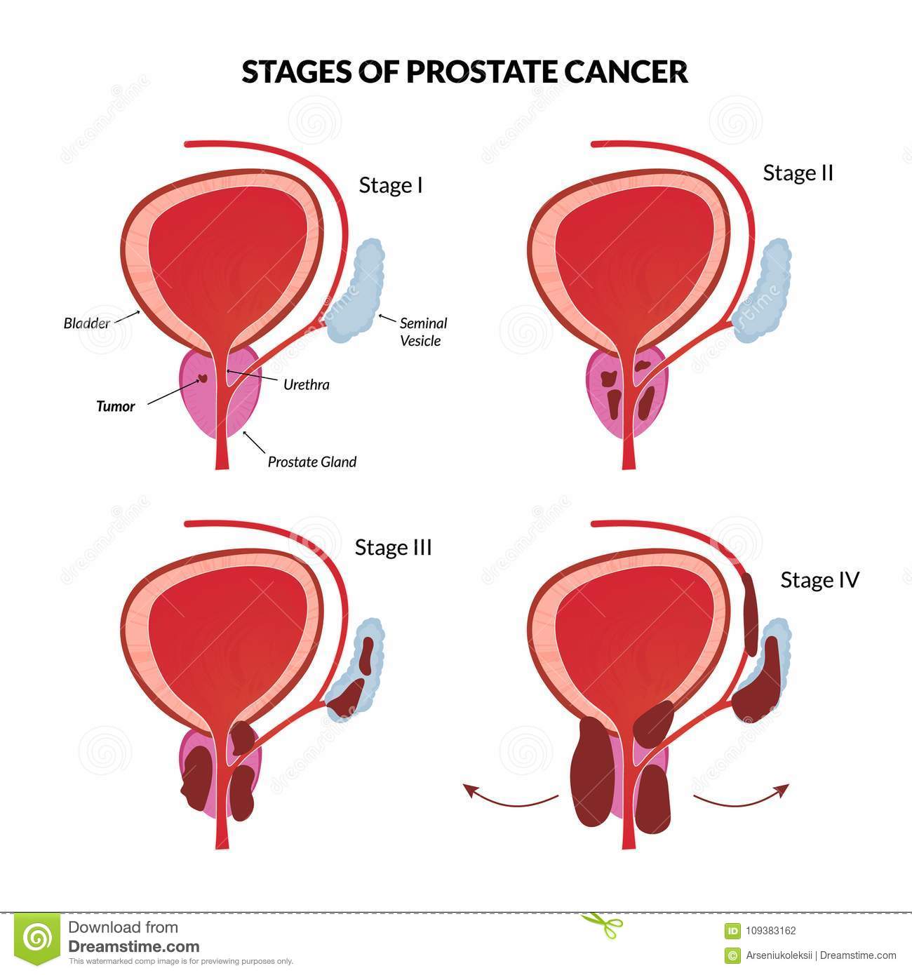 Quatro Fases Do Câncer Da Próstata Ilustração do Vetor