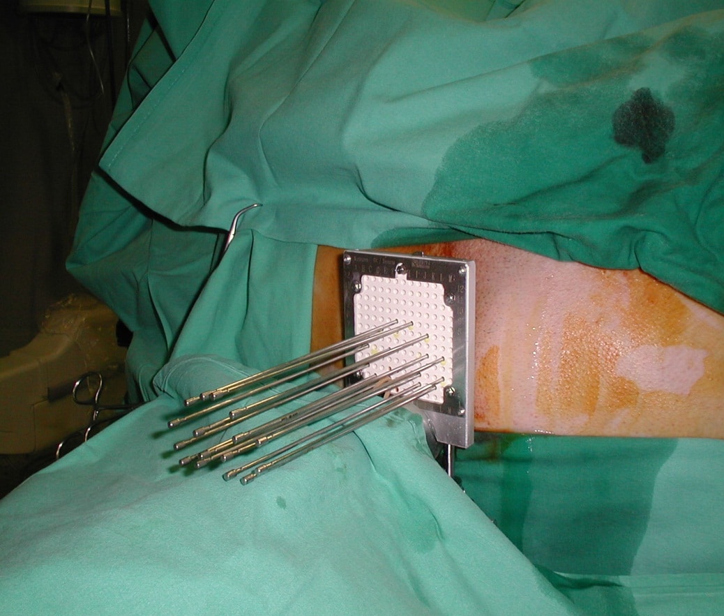 Radiation Implants For Prostate Cancer
