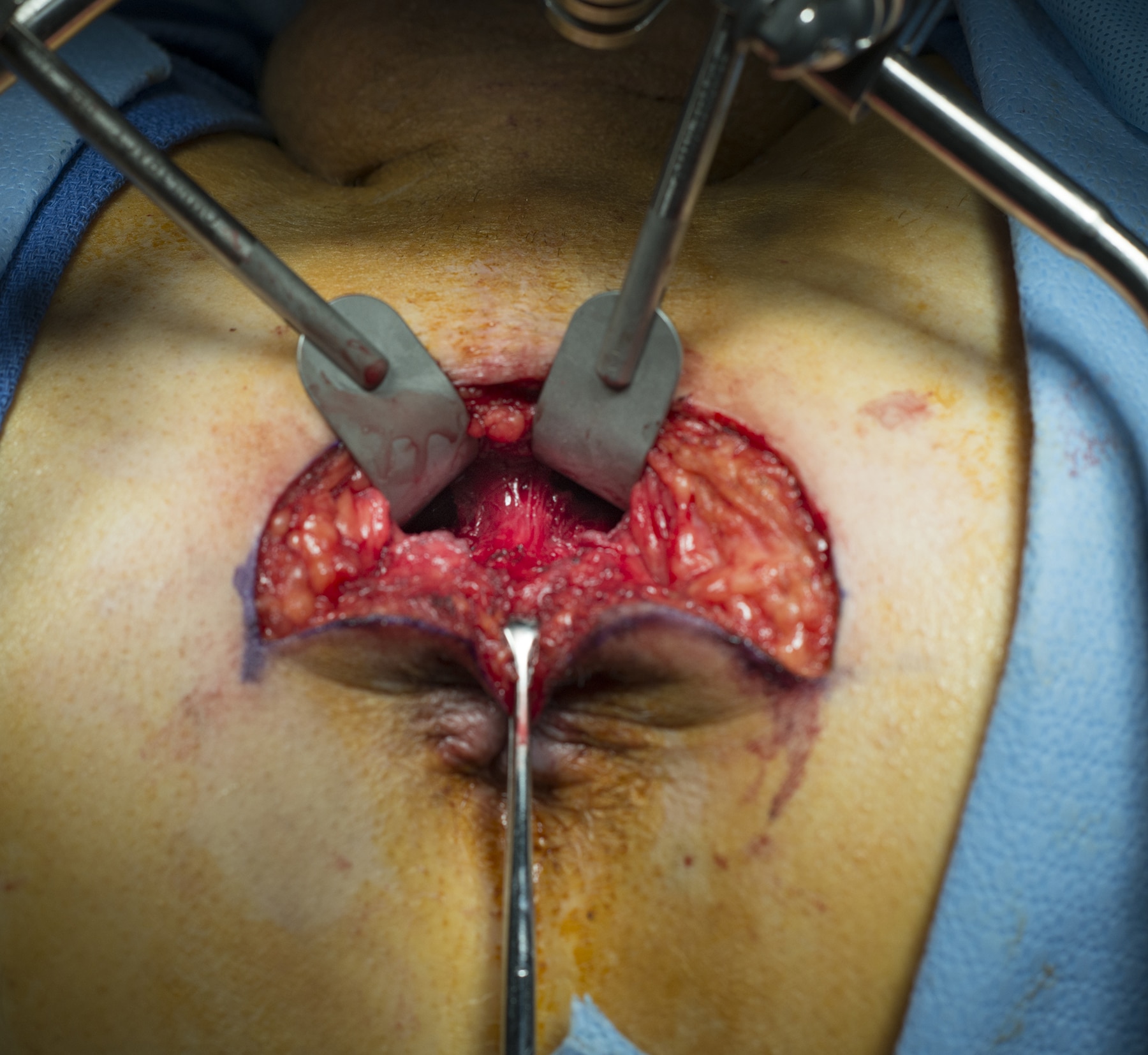 Radical perineal prostatectomy