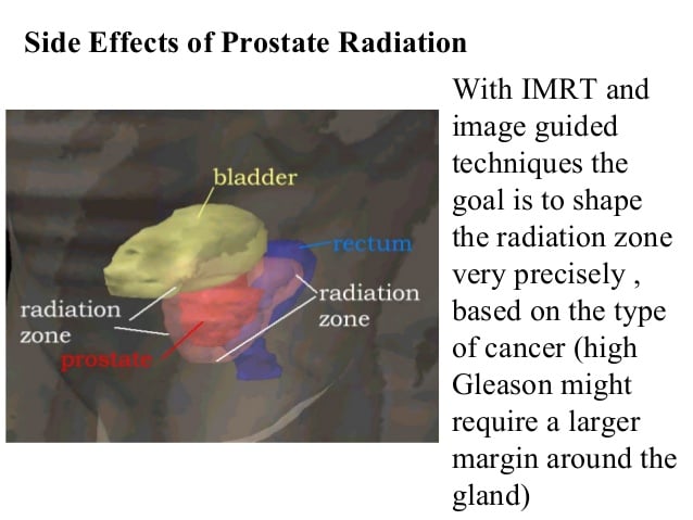 Radiotherapy for Prostate Cancer