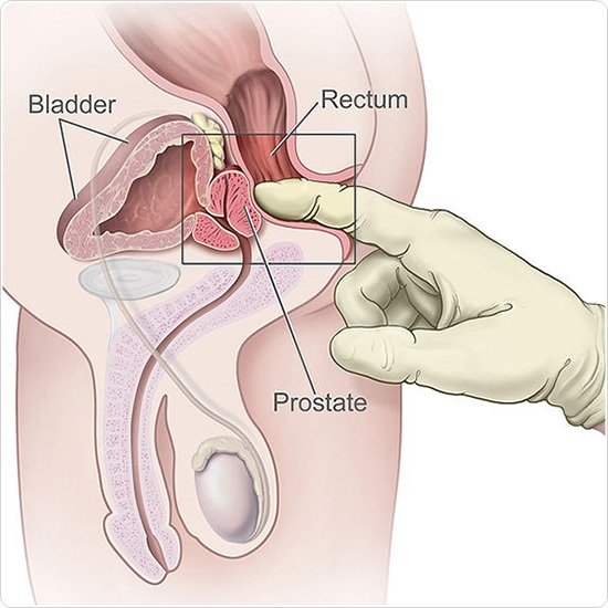 Rectal Examination for Prostate Cancer