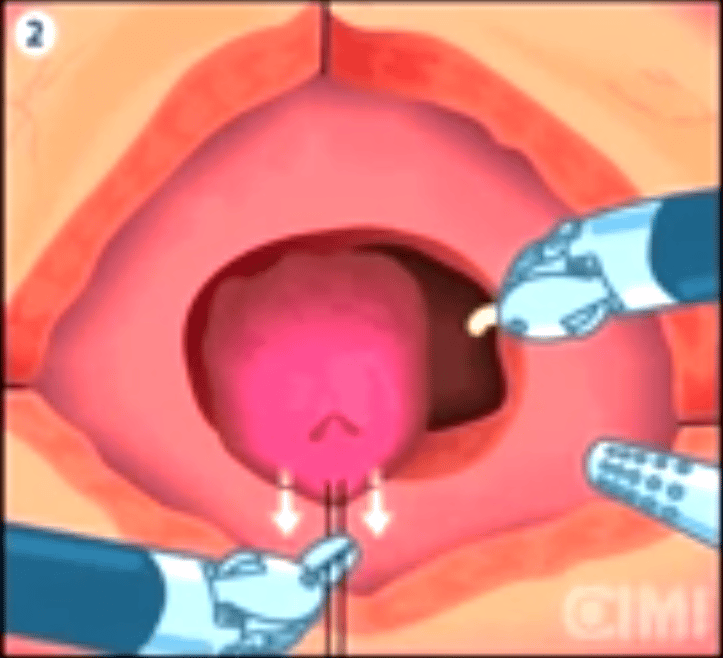 Robotic Simple Prostatectomy