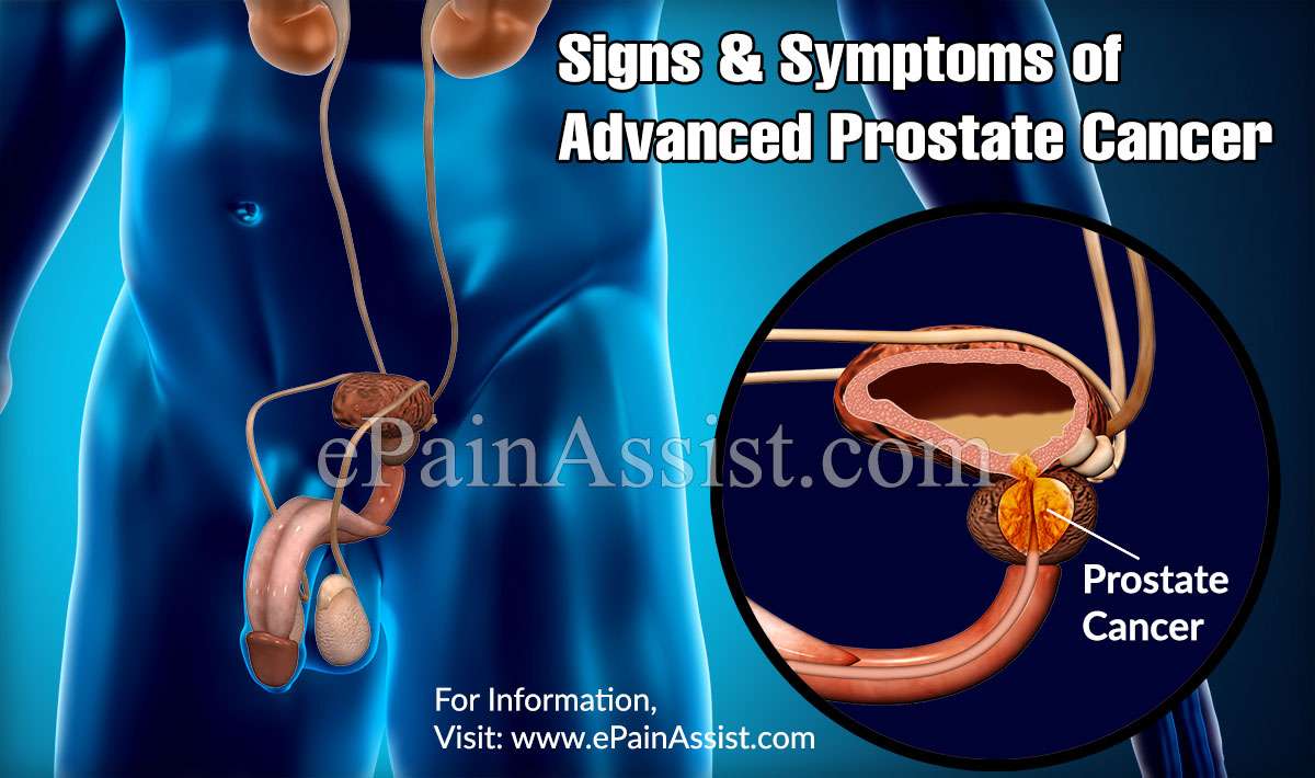 Signs &  Symptoms of Advanced Prostate Cancer
