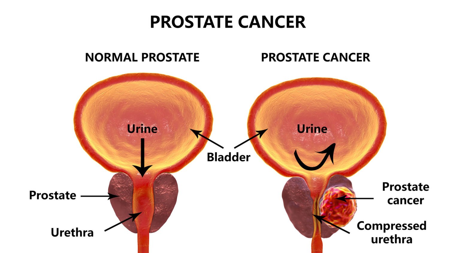 Stage 4 Prostate Cancer: Living Beyond Diagnosis, and ...