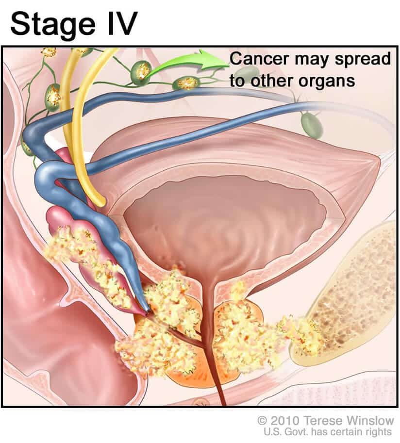 Stage 4 Prostate Cancer Treatment