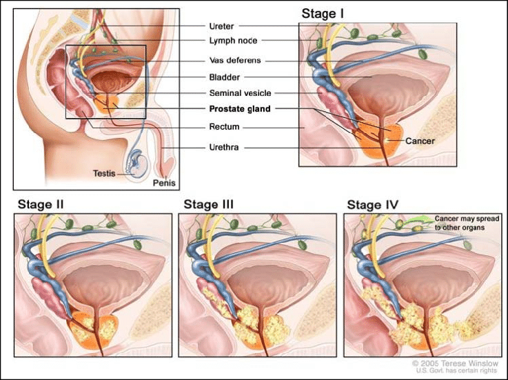 Stages in prostate cancer. The above figure shows the four ...