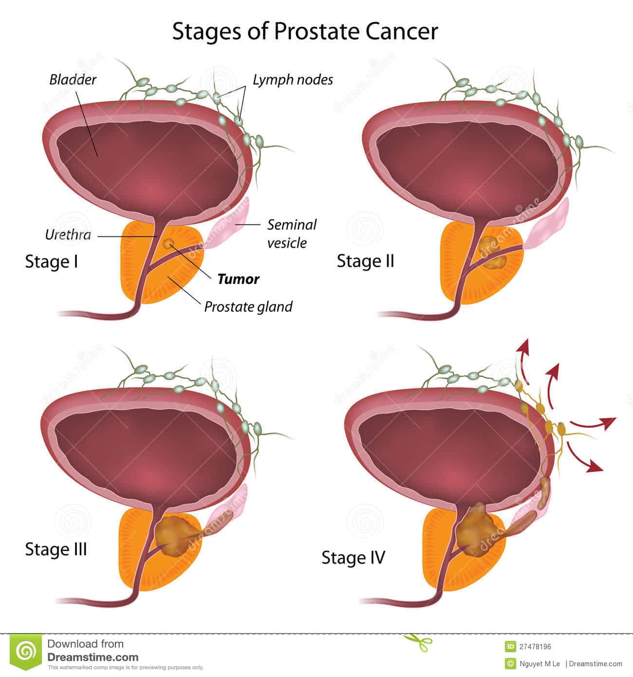 Stages Of Prostate Cancer Royalty Free Stock Image