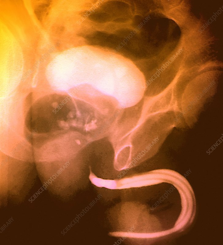 stones in the prostate gland x ray stock image c003