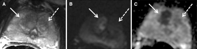 Stromal benign prostatic hyperplastic (BPH) nodule vs ...