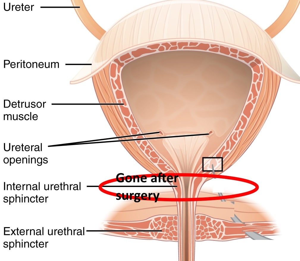 Surgery For Incontinence After Prostate Removal