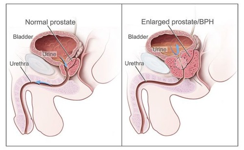 Symptoms of Prostate Problems You Need To Know That ...