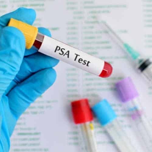 Tampa Prostate Specific Antigen Test