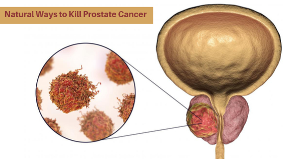 The Best Natural Ways to Kill Prostate Cancer