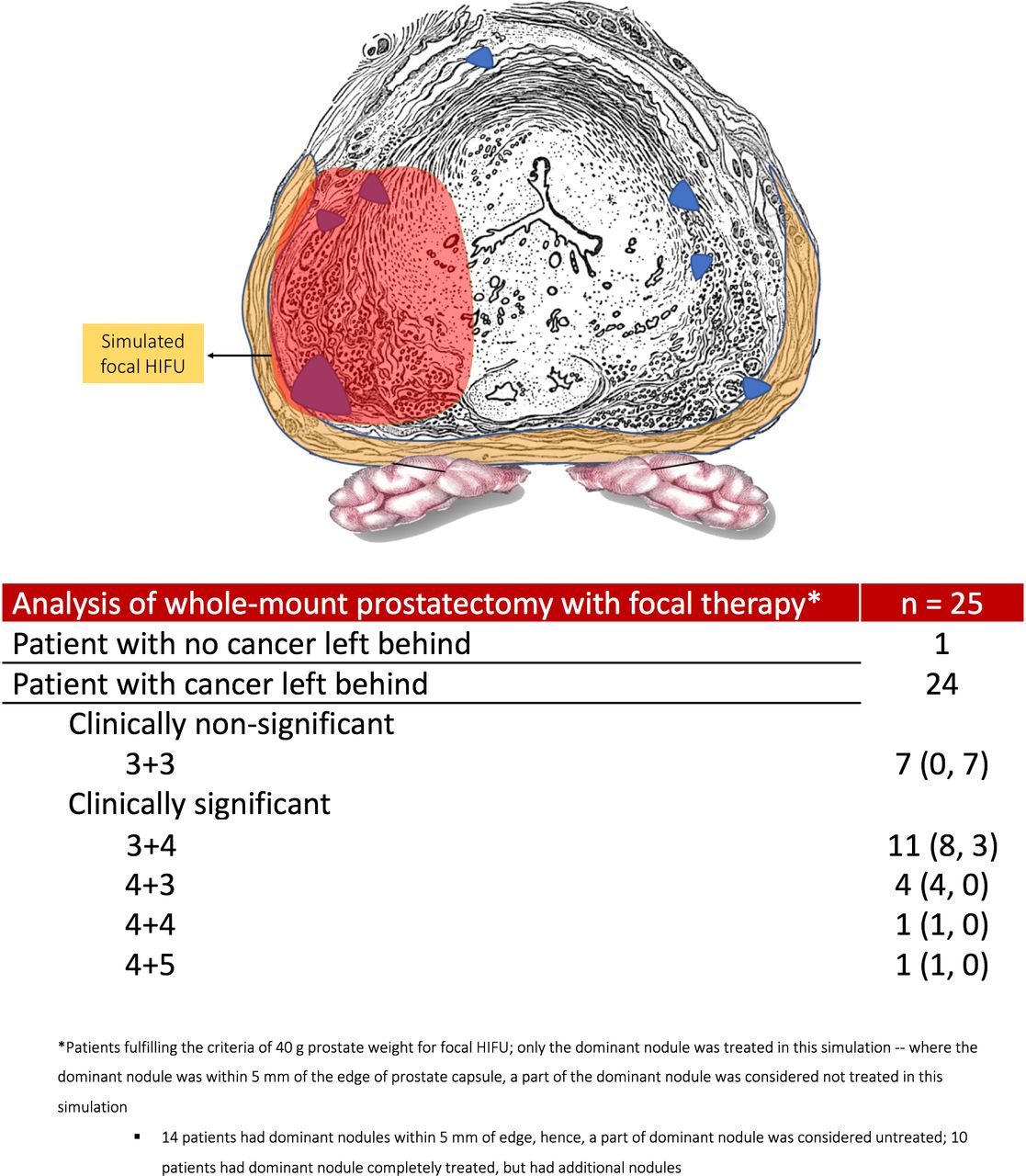 The Precision Prostatectomy: an IDEAL Stage 0, 1 and 2a Study