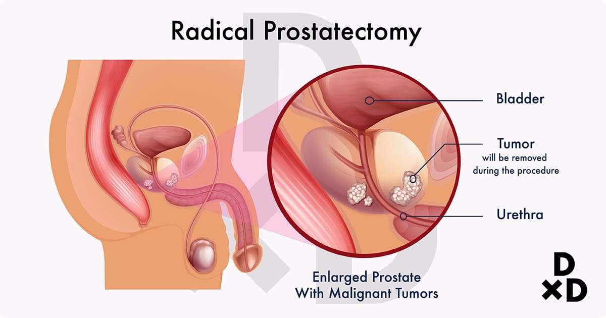 The Ultimate Guide To Dealing With Prostate Cancer By A Singaporean ...