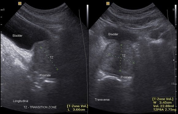 Transabdominal ultrasound of the prostate showing ...