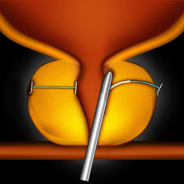 TURP (Transurethral resection of the prostate)