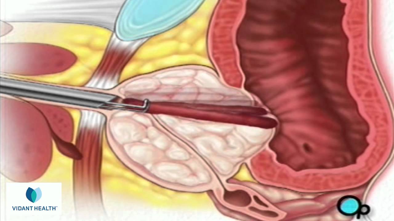 TURP Transurethral Resection Prostate Vidant PreOp ...