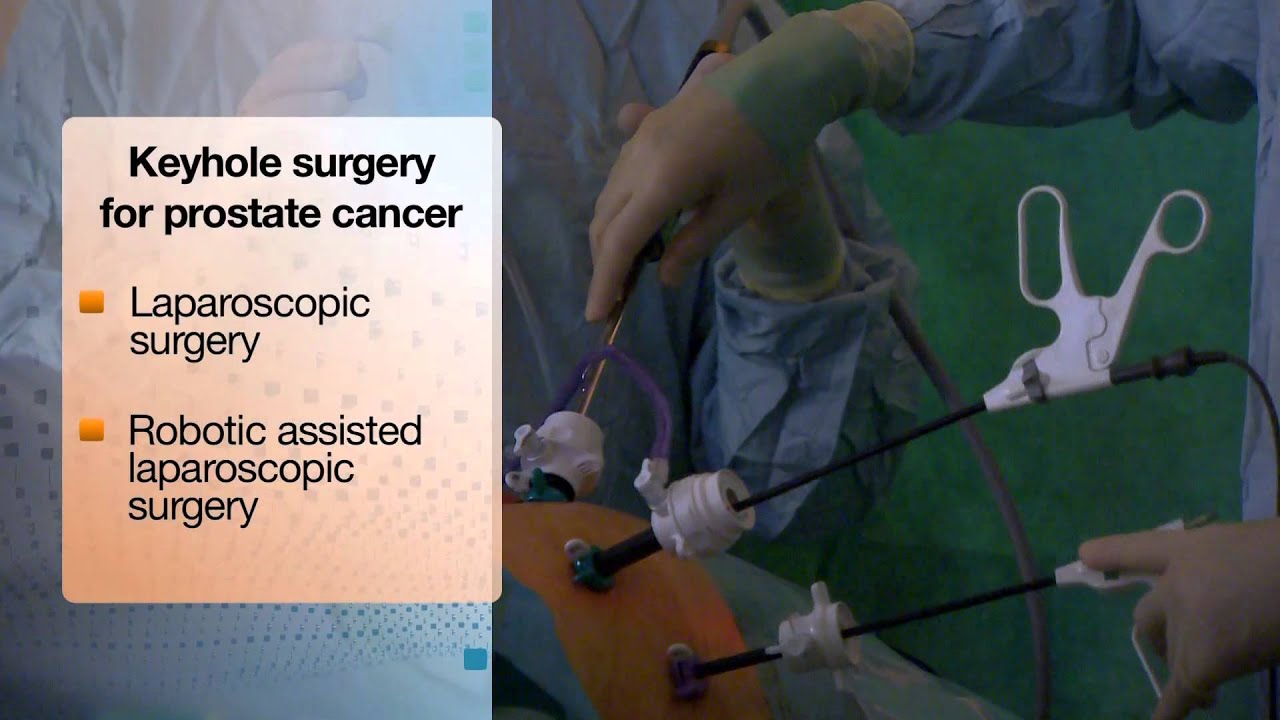 Types of Surgery to Treat Prostate Cancer